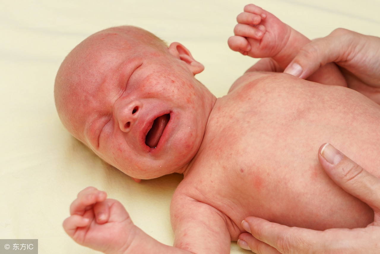 宝宝长湿疹原因,四个月的婴儿口水疹和湿疹的区别