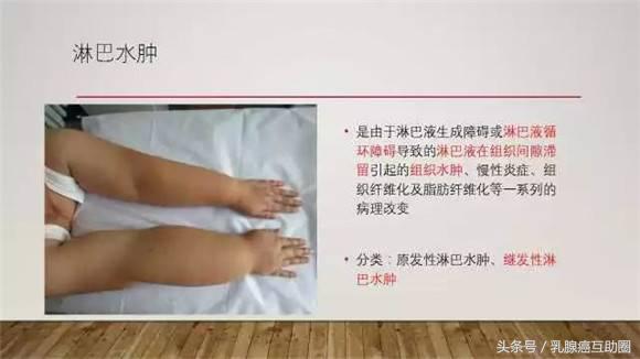 乳腺癌术后淋巴水肿预防和治疗ppt,乳腺癌术后淋巴水肿的护理论文