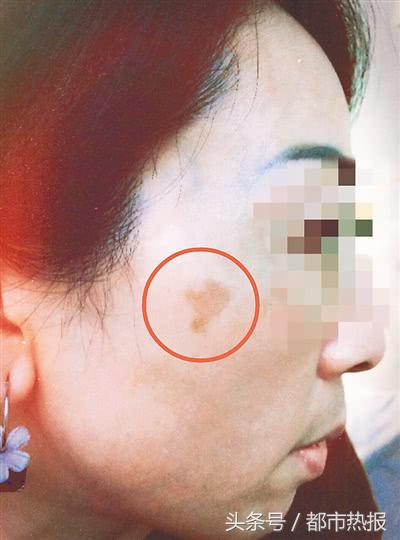 女子去美容医院,医院祛斑斑很淡