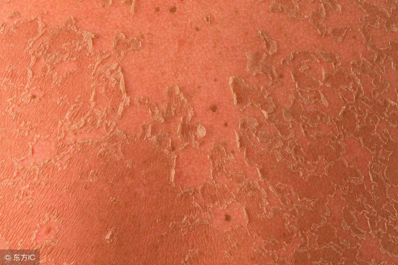 日晒后的皮肤怎么护理,皮肤干燥需要防晒吗