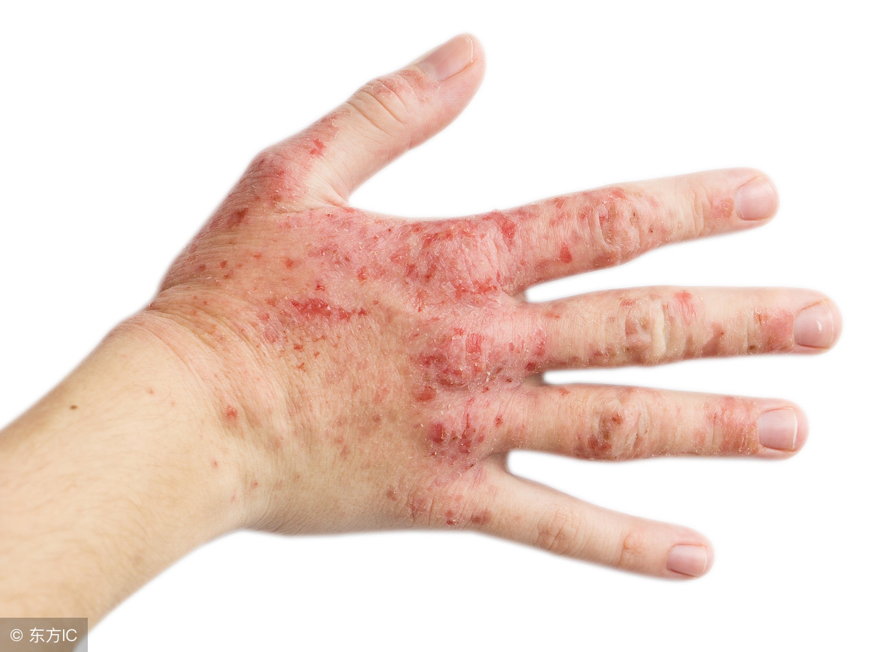 神经性皮炎在饮食上注意什么,得了神经性皮炎吃什么口服药