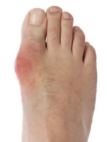 为什么越来越多的年轻人患痛风,为什么年轻人会得痛风呢能痊愈吗