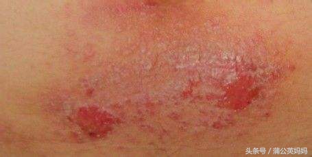 30多天的宝宝湿疹的最佳治疗方法,两岁半宝宝湿疹的最佳治疗方法