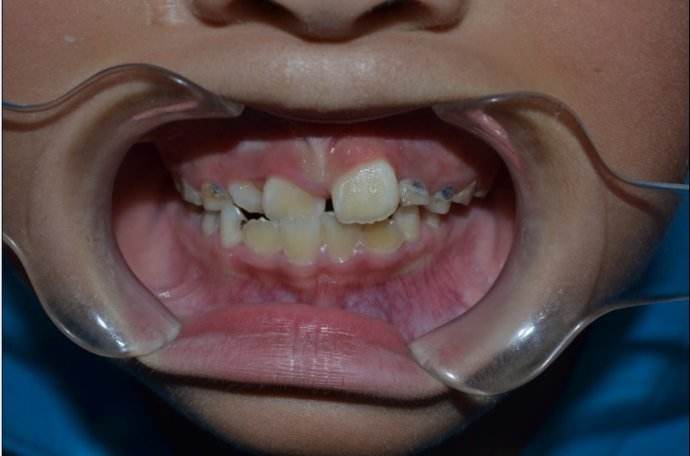 乳牙能退，所以龋坏不用补？出现这些问题，后悔都来不及