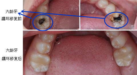 乳牙能退，所以龋坏不用补？出现这些问题，后悔都来不及