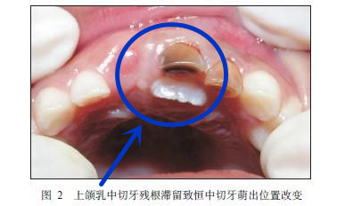 乳牙能退，所以龋坏不用补？出现这些问题，后悔都来不及