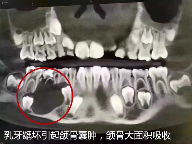 乳牙能退，所以龋坏不用补？出现这些问题，后悔都来不及