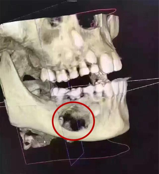 乳牙能退，所以龋坏不用补？出现这些问题，后悔都来不及