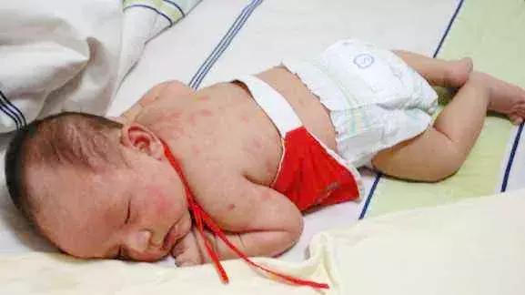 张景明讲病毒性肺炎的方子,姜治咳嗽支气管肺炎