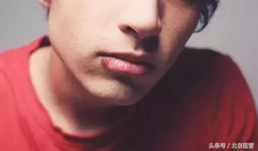 牙龈上火嘴上起泡一直不消怎么整,嘴上起泡怎么判断是上火还是疱疹