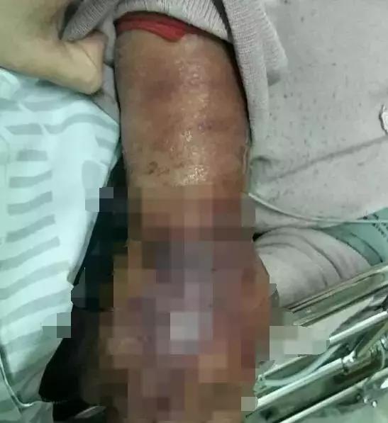 只是擦破点皮,台州女子整条手臂都黑了!3天后可怕一幕出现!