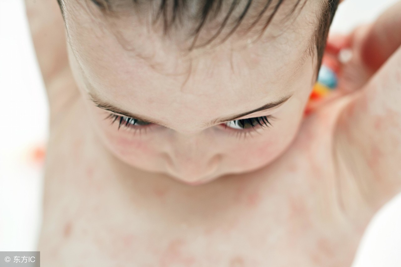 孩子湿疹有妙方,宝宝湿疹怎么治最有效的方法