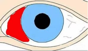 一觉醒来就成了熊猫眼怎么补救,一觉醒来就变成熊猫眼怎么办