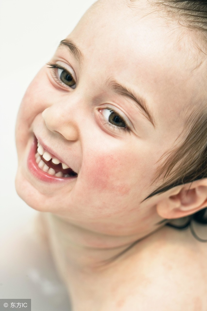 孩子湿疹有妙方,宝宝湿疹怎么治最有效的方法