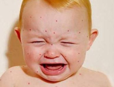 家长注意小孩感冒发烧流感,宝宝发烧咳嗽流鼻涕身上起红疹