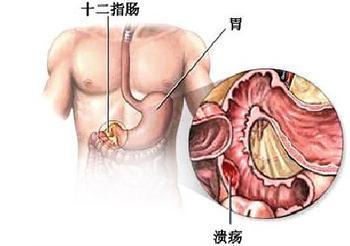 餐后腹痛便后减轻,餐后腹痛是什么原因