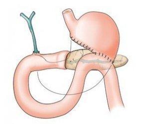 餐后腹痛便后减轻,餐后腹痛是什么原因