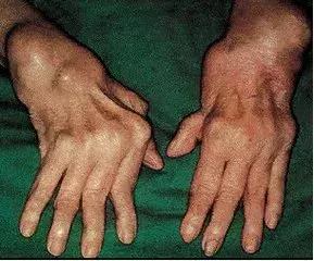 得了类风湿不治疗关节多久会变形,类风湿变形的关节靠锻炼能矫正吗