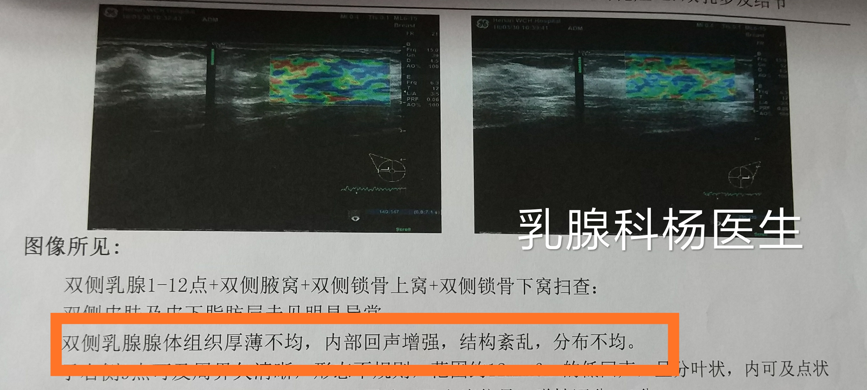 主任答疑,医生说有乳腺增生怎么回事