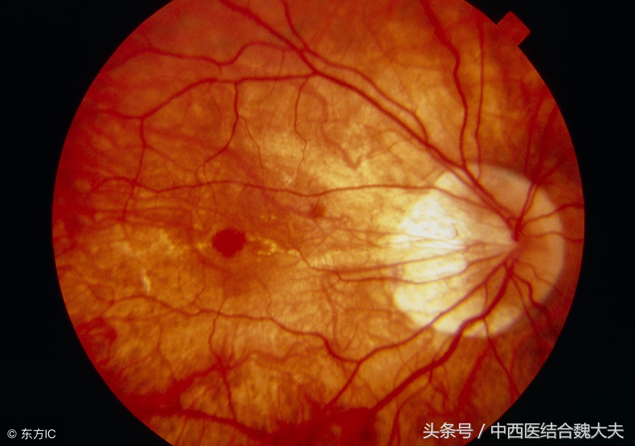 视神经炎可以中药治疗吗能治好吗,视神经炎如何治疗最好