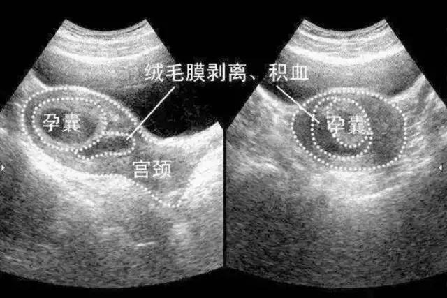 绒毛膜下血肿机化是什么意思,怀孕后绒毛膜下血肿是怎么回事