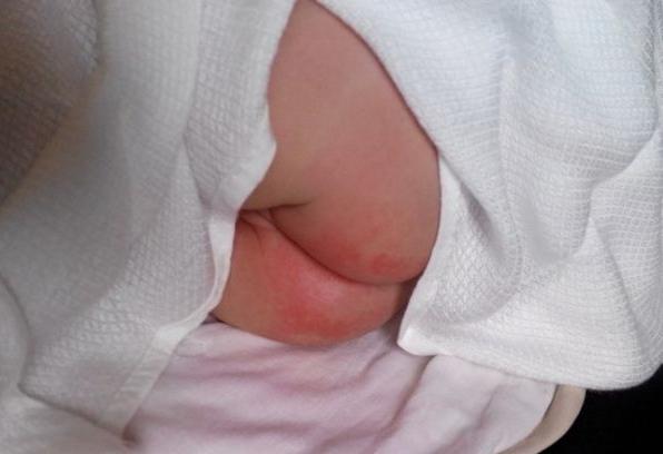 尿布疹皮炎发痒怎么治疗,娃脸上和屁股上湿疹反复发作