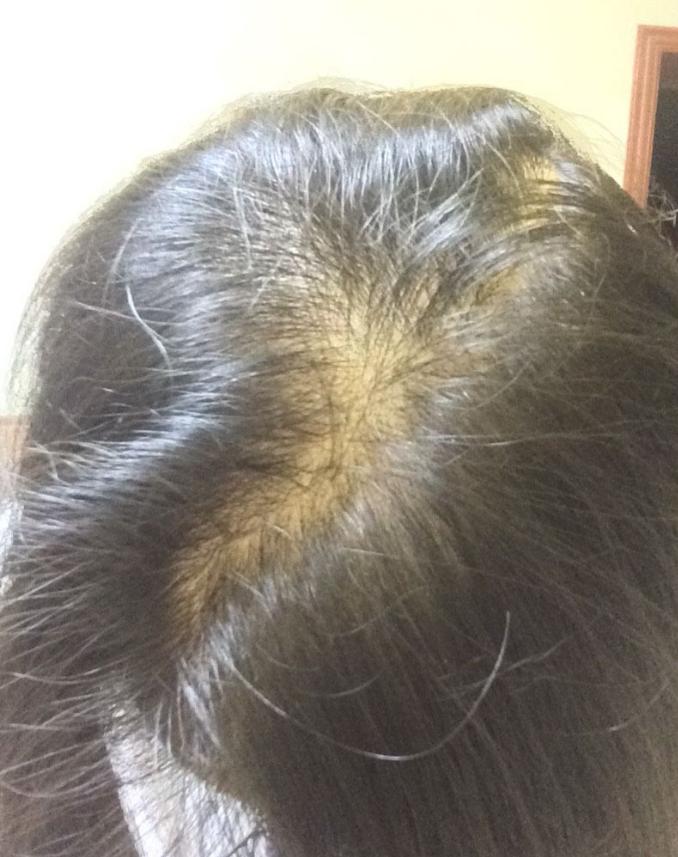 非那雄胺治疗脱发过程,记录治疗脱发每一天