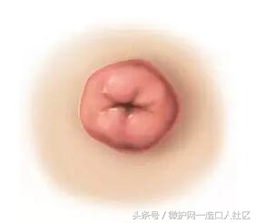 如果有造口要怎么护理,临时造口边上皮肤破损怎么护理