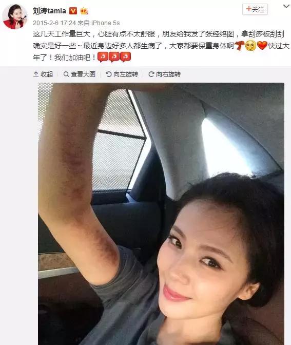 触目惊心!杨丞琳阿娇等人把刮痧过度神话,专家打脸:根本没效果