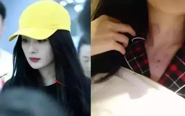 触目惊心!杨丞琳阿娇等人把刮痧过度神话,专家打脸:根本没效果