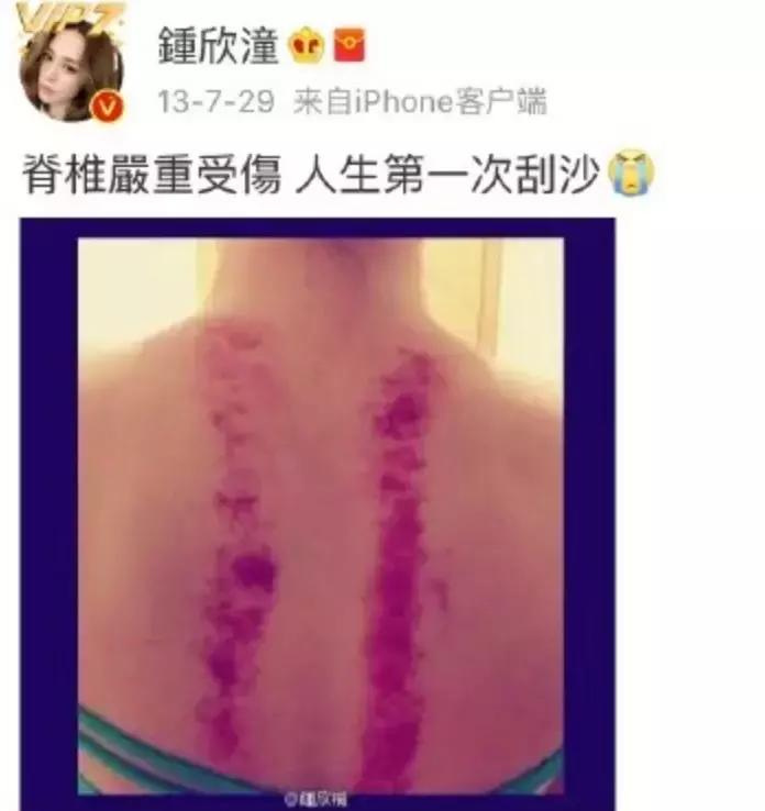 触目惊心!杨丞琳阿娇等人把刮痧过度神话,专家打脸:根本没效果