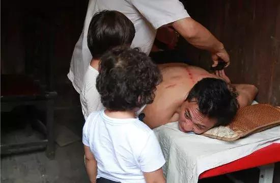 触目惊心!杨丞琳阿娇等人把刮痧过度神话,专家打脸:根本没效果