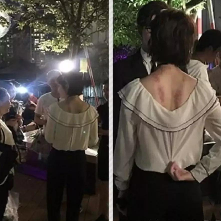 触目惊心!杨丞琳阿娇等人把刮痧过度神话,专家打脸:根本没效果