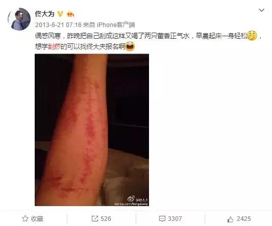触目惊心!杨丞琳阿娇等人把刮痧过度神话,专家打脸:根本没效果