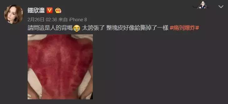 触目惊心!杨丞琳阿娇等人把刮痧过度神话,专家打脸:根本没效果