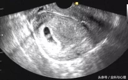 有胎心胎芽先兆流产保胎成功率,9周先兆流产的保胎几率有多大