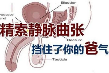 精索静脉曲张2.5,精索静脉曲张