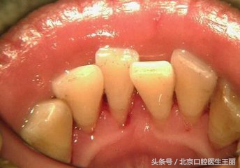 防牙龈萎缩牙膏,倪海厦牙龈萎缩