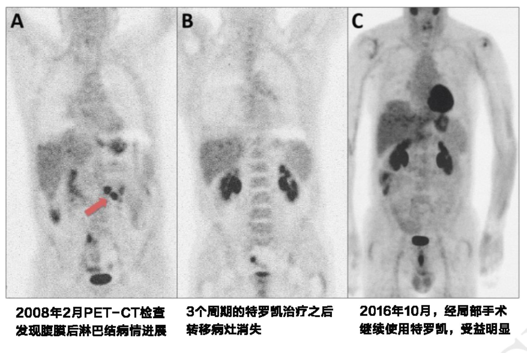 特罗凯为什么会耐药,特罗凯吃5年停药