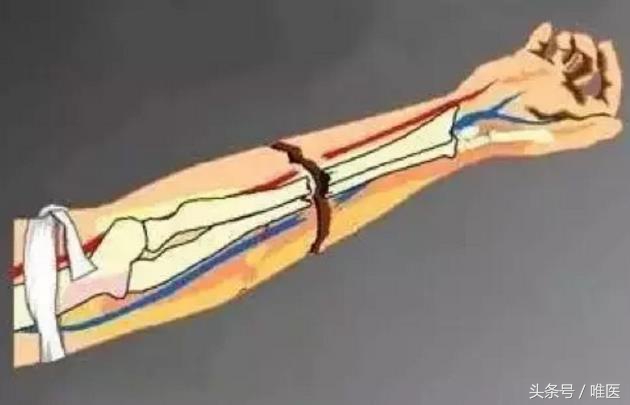 缓解截肢后疼痛的办法,截肢后的幻肢痛怎么解决日常生活