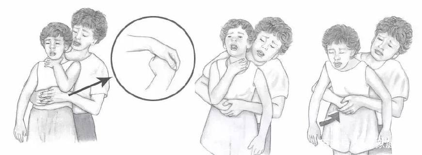 儿童误食火碱受伤,男童误吞火碱