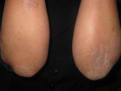 梁医生讲皮肤瘙痒怎么办,医生分享皮肤痒都用什么药抹