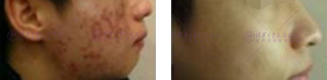 想要祛痘印用什么精华比较好,想要祛除痘印需要做什么医美