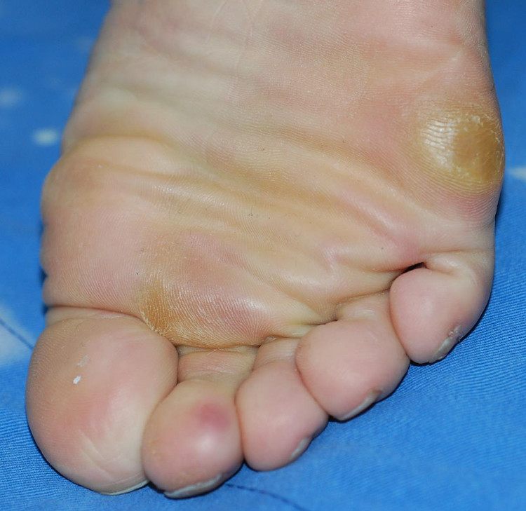 脚下出现老茧很严重该如何去除呢,脚下为什么长老茧