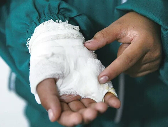 别人手筋砍断了怎么办,手指被割断筋脉两个月还没知觉