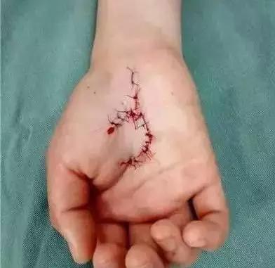 别人手筋砍断了怎么办,手指被割断筋脉两个月还没知觉