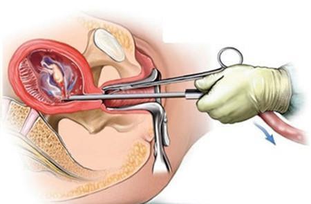 孩子被打掉是什么过程,孩子是怎样被打掉的