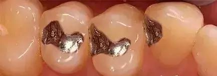 补过的牙突然一咬东西就酸痛,补过的牙喝凉的酸痛