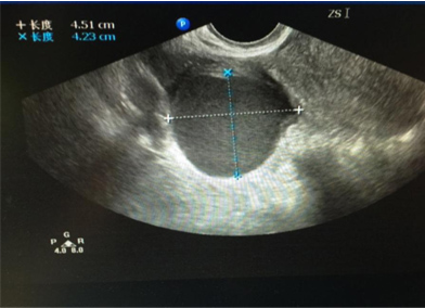 卵巢囊肿手术能报销吗,卵巢冠囊肿多大要手术