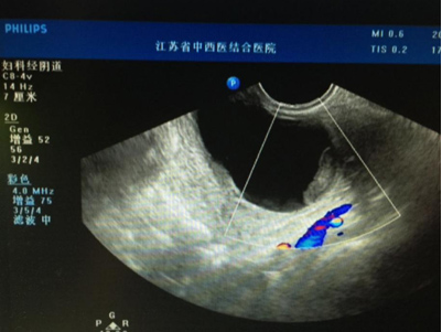 卵巢囊肿手术能报销吗,卵巢冠囊肿多大要手术